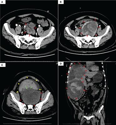 Case report: Adult NTRK-rearranged spindle cell neoplasms with TPM3-NTRK1 fusion in the pelvic